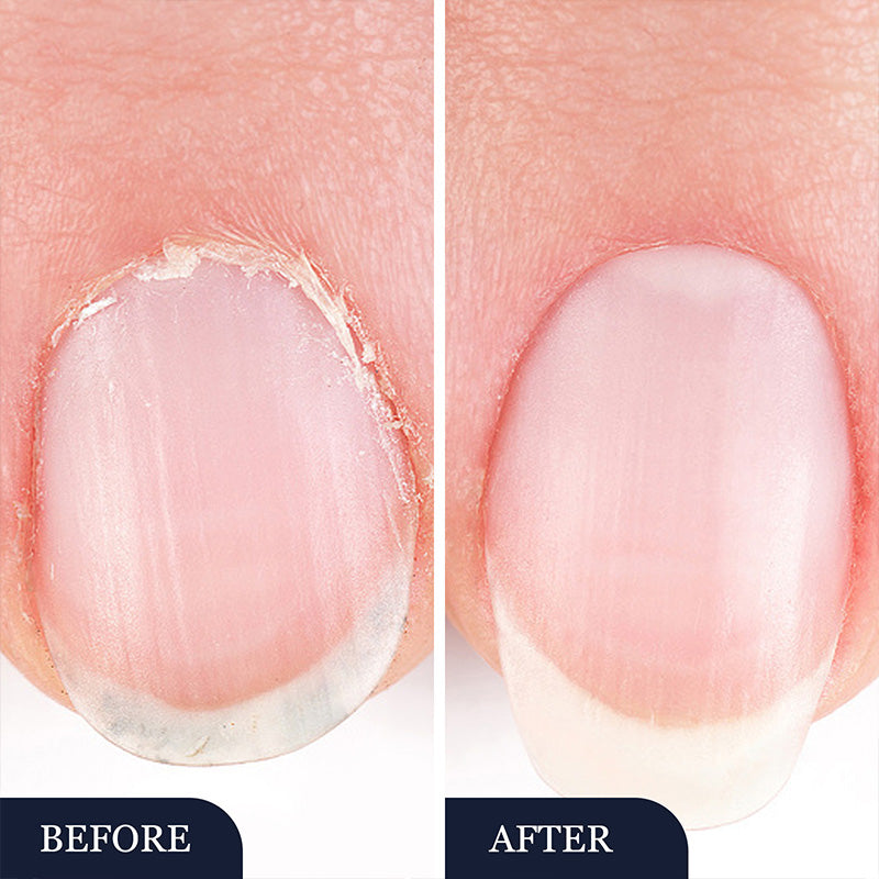 ✨New product launch🔥Toenail fungus treatment pen for damaged nails